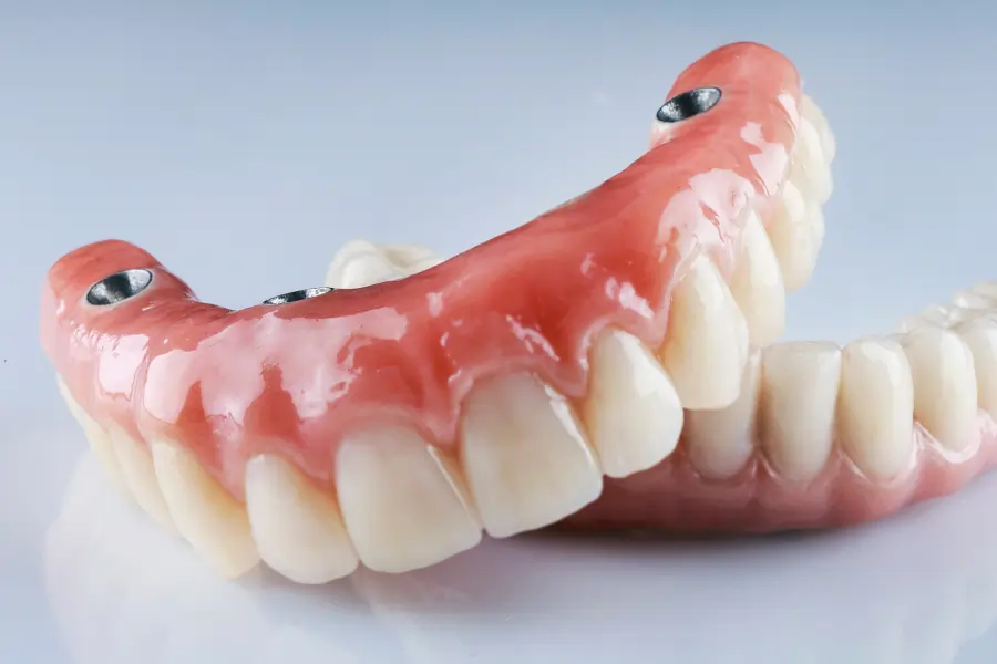 implant-retained-dentures